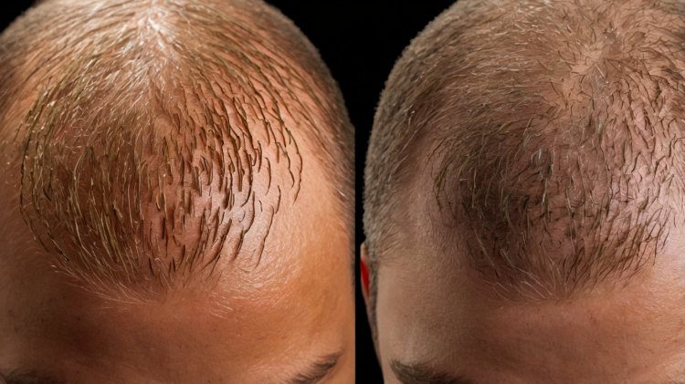 Understanding DHT and Its Role in Hair Loss: Causes, Effects, and Treatments